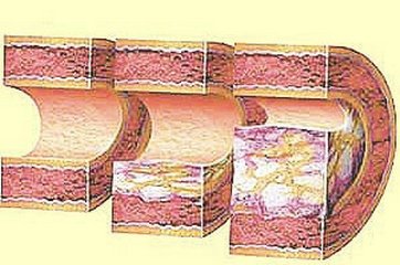 Очищение при атеросклерозе